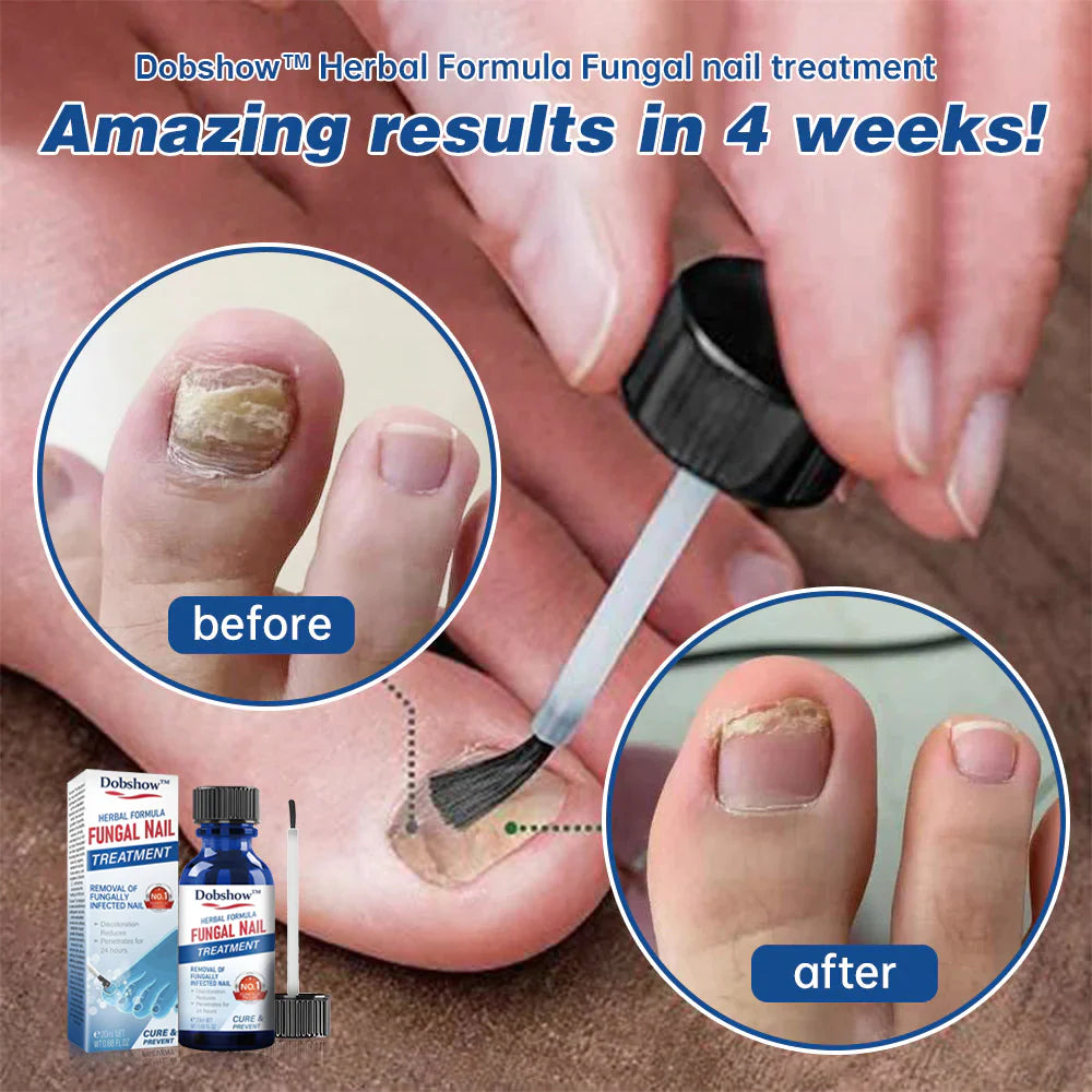 Dobshow™ Herbal Formula Fungal Nail Paronychia Treatment Gel