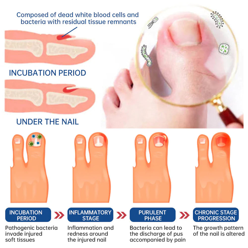 Dobshow™ Herbal Formula Fungal Nail Paronychia Treatment Gel