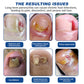Dobshow™ Herbal Formula Fungal Nail Paronychia Treatment Gel