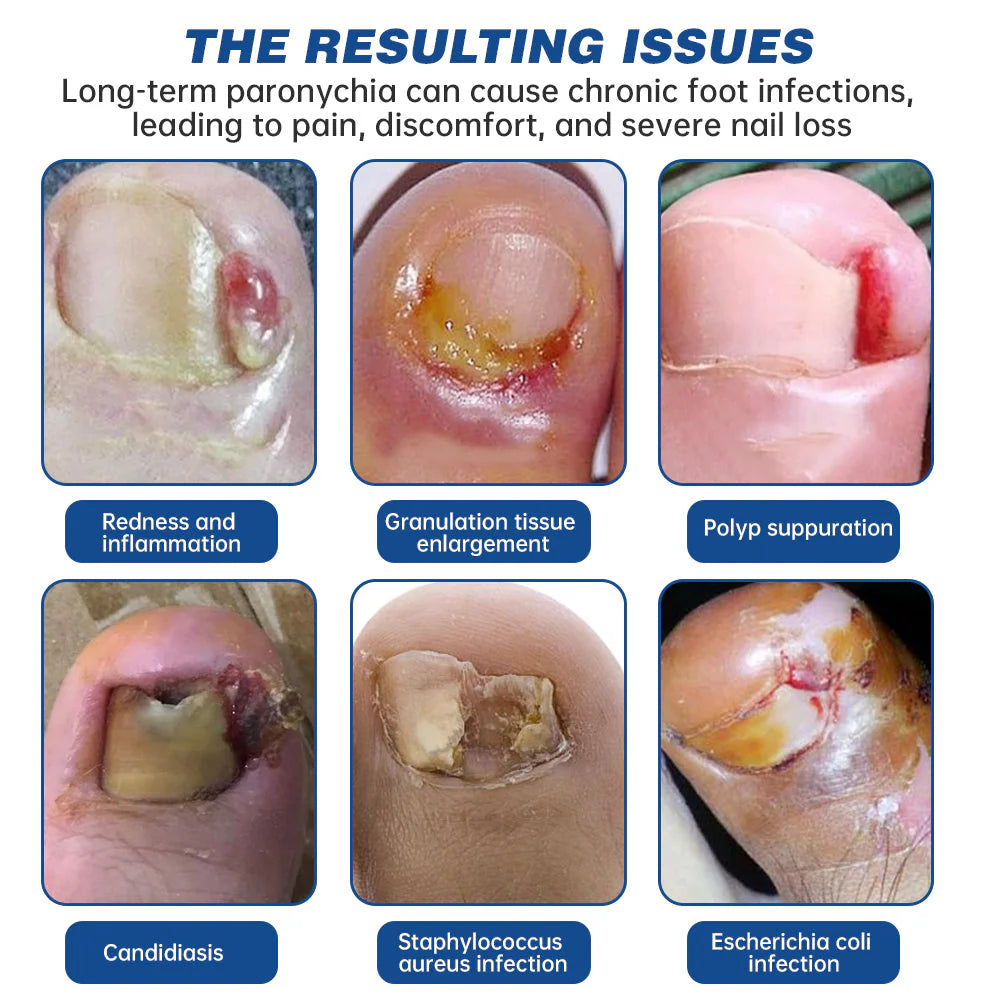 Dobshow™ Herbal Formula Fungal Nail Paronychia Treatment Gel