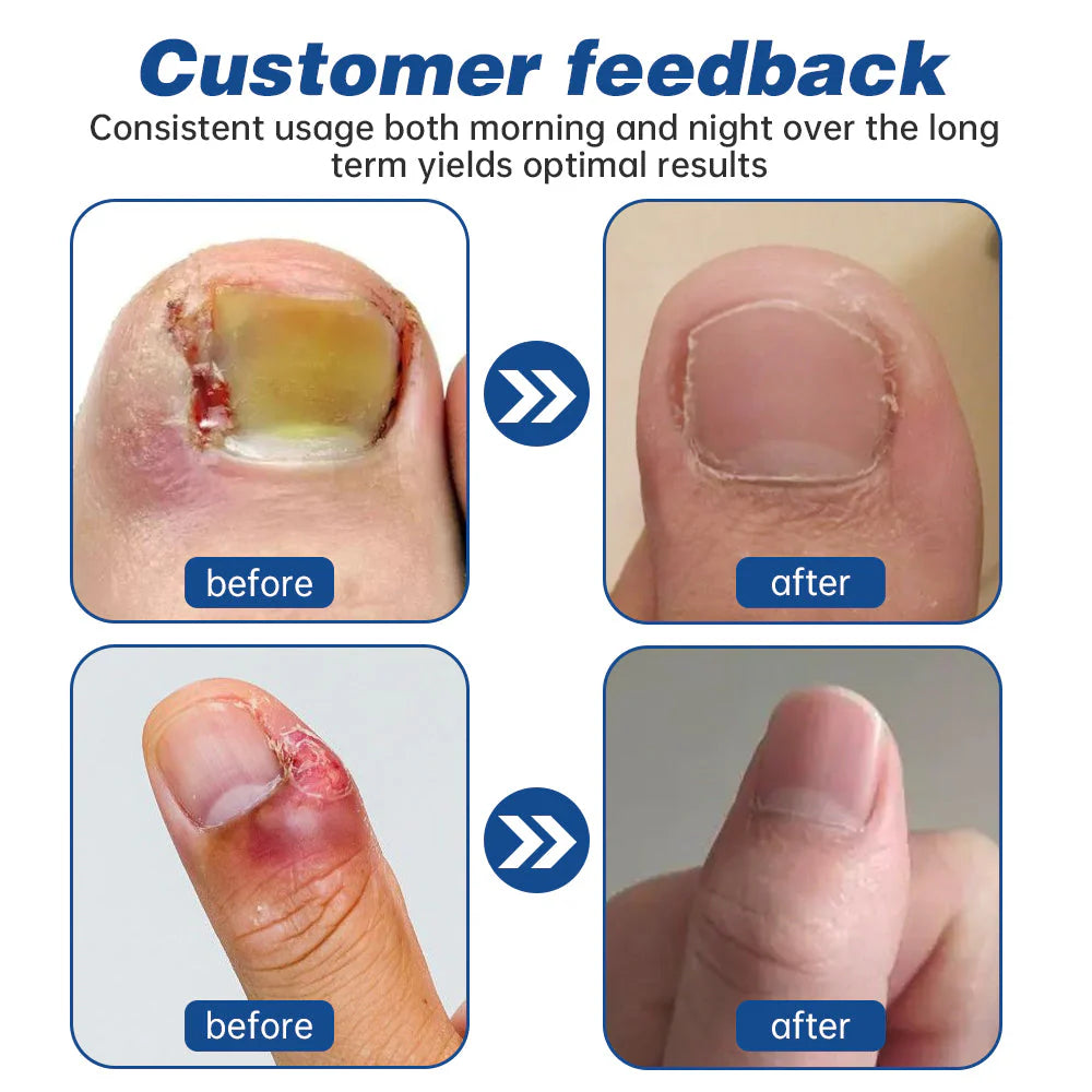Dobshow™ Herbal Formula Fungal Nail Paronychia Treatment Gel