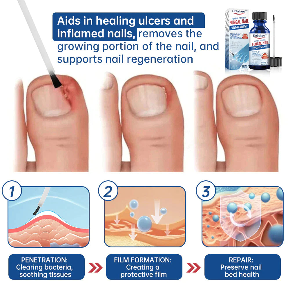 Dobshow™ Herbal Formula Fungal Nail Paronychia Treatment Gel